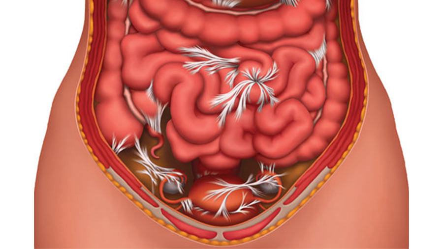 Adhesiolysis: What Conditions Are Treated with Adhesiolysis?