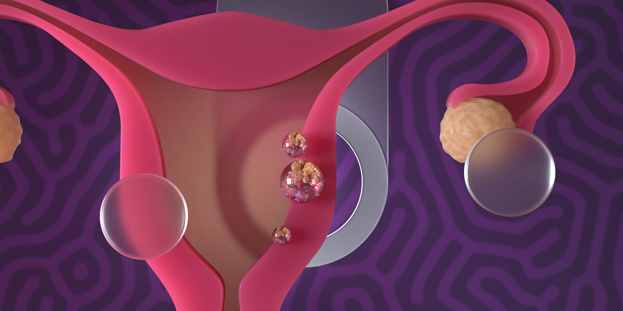 Understanding Endometrial Cancer: Causes, Symptoms, and Treatments